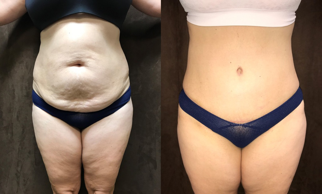 Liposuction before and after photo by Fort Worth Plastic Surgery in Fort Worth, TX