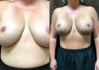 Breast Augmentation With Lift Before and After photo