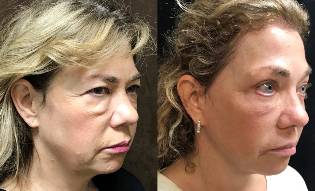 Facelift before and after photo by Fort Worth Plastic Surgery in Fort Worth, TX