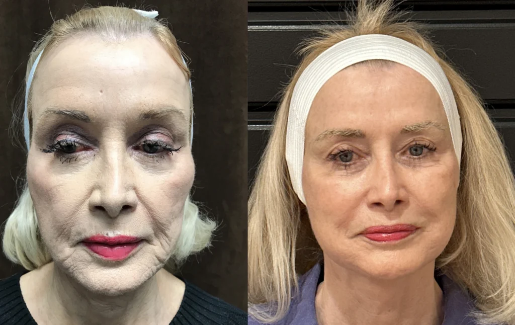 Facelift before and after photo by Fort Worth Plastic Surgery in Fort Worth, TX