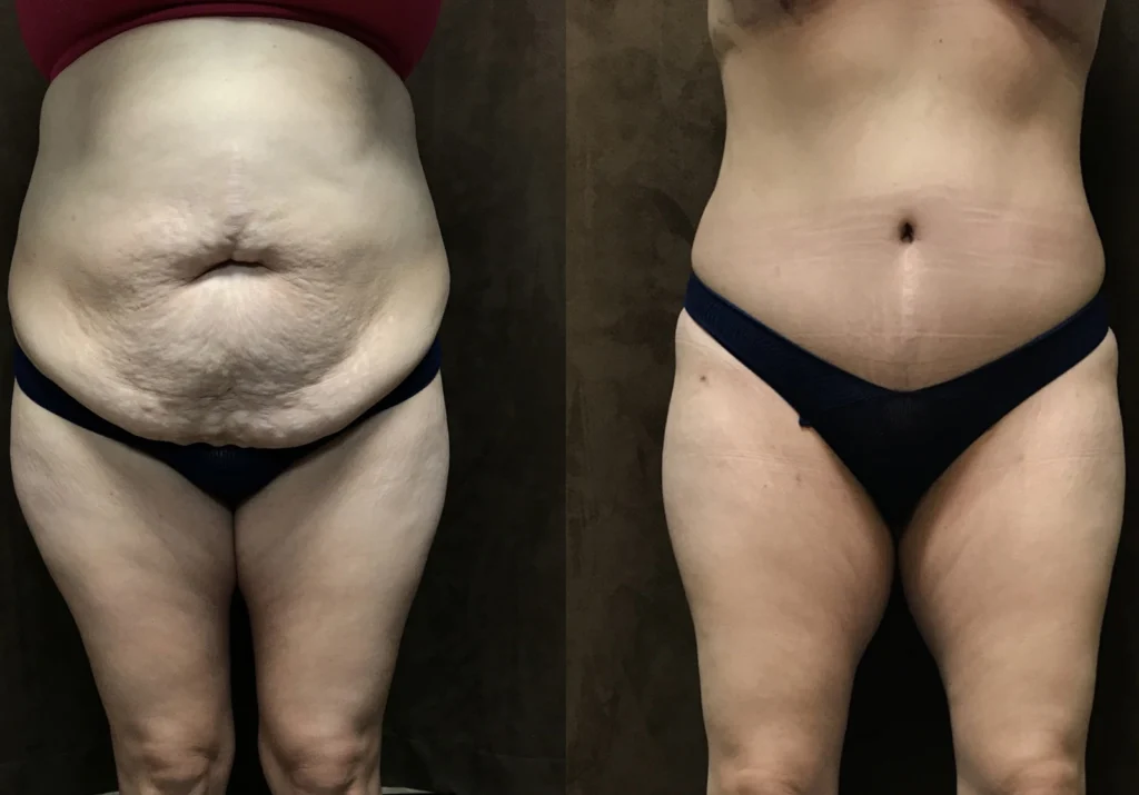 Tummy Tuck before and after photo by Fort Worth Plastic Surgery in Fort Worth, TX