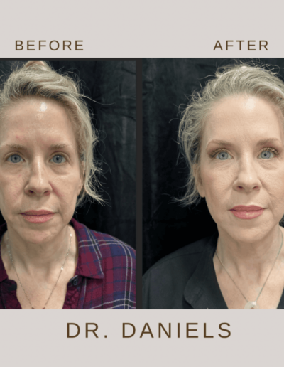 Before and After MyEllevate® procedure photo