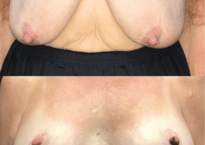 Breast Augmentation With Lift Before and After photo