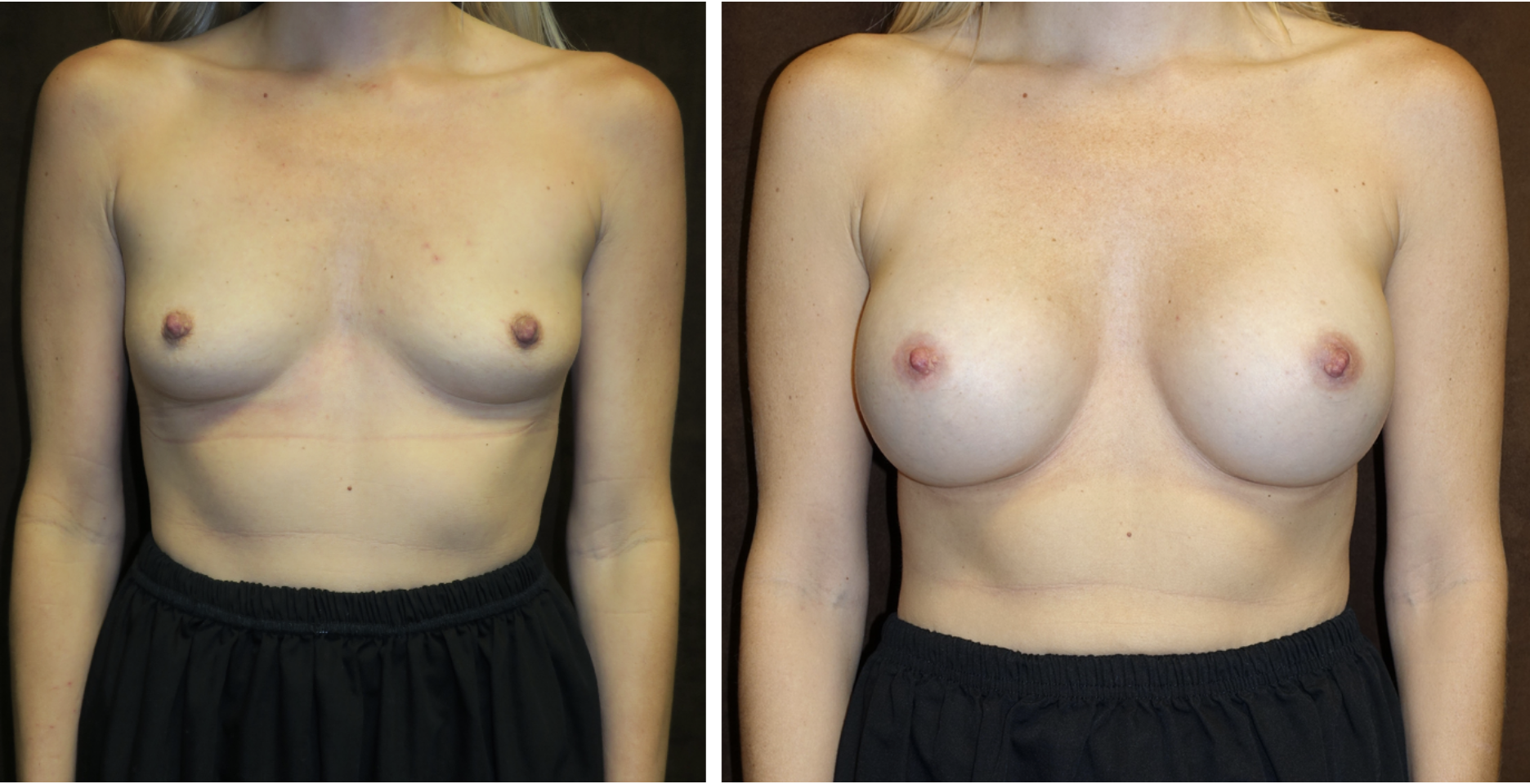 Patient 1: Before and After Breast Augmentation